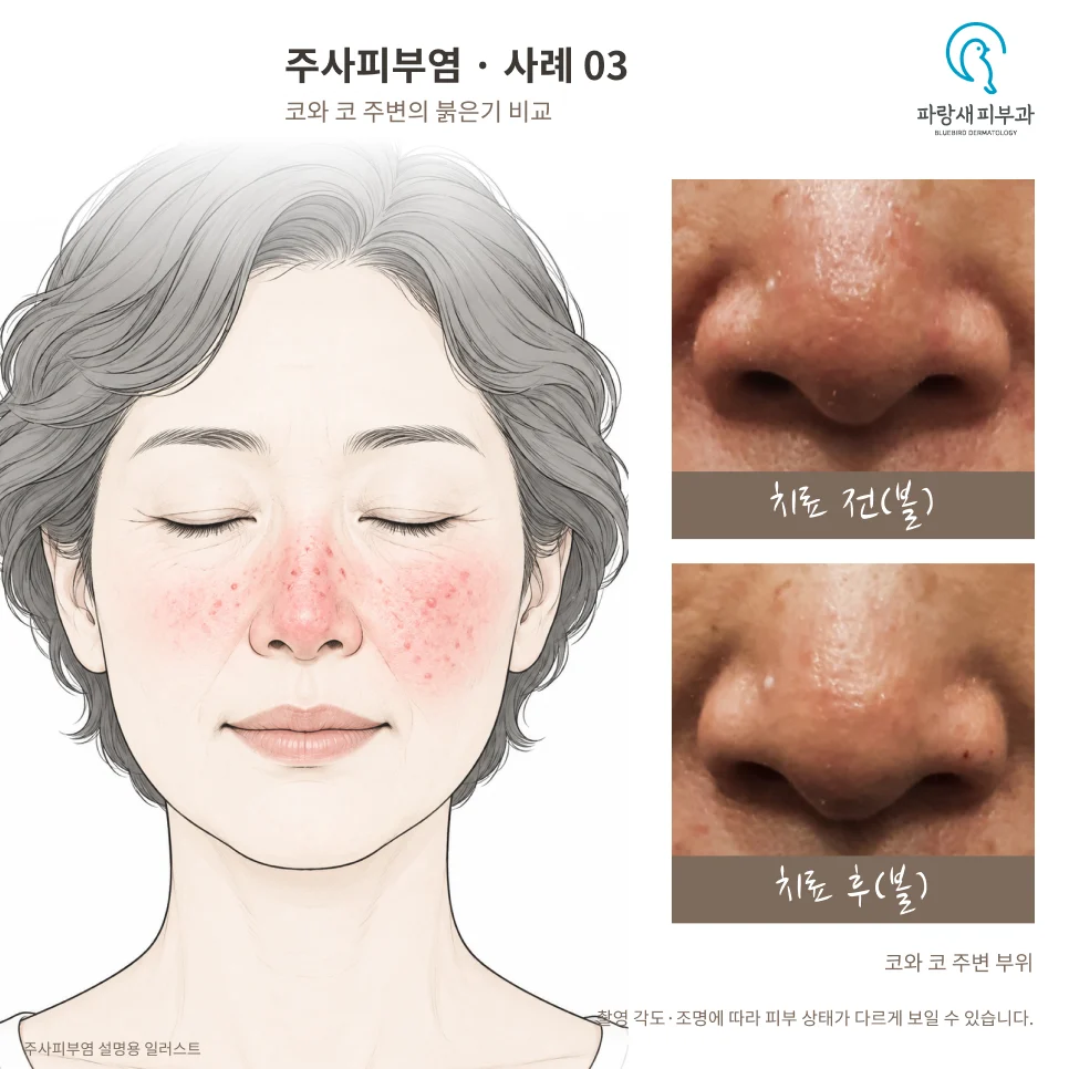 50대 여성 양쪽 볼 주사피부염 PRP·큐어젯·실펌 X 치료 전후. 각 줄 왼쪽은 치료 전, 오른쪽은 치료 후