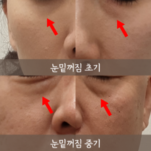 눈밑꺼짐에 효과적인 스킨부스터 찾기
