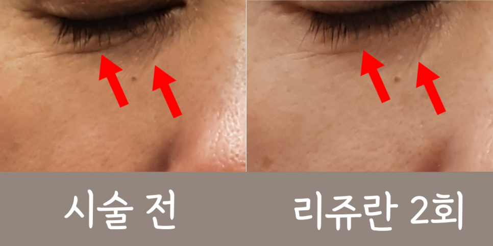 콜라겐 부스터 시술 안내 1