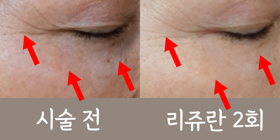 콜라겐 부스터 시술 안내 2
