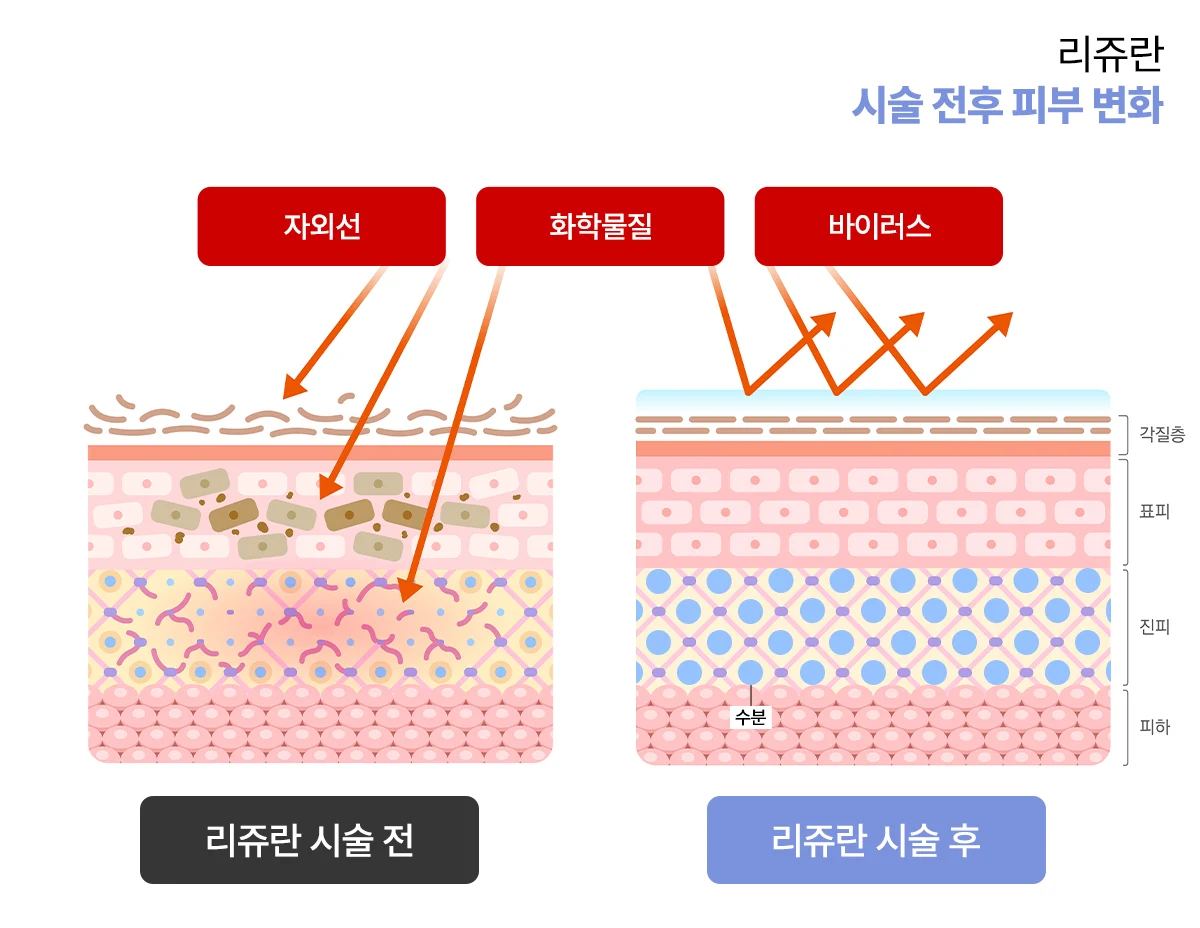 피붓결 개선 효과 리쥬란