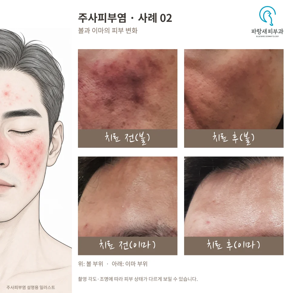 40대 남성 주사피부염 PRP·큐어젯·실펌 X 치료 전후. 각 줄 왼쪽은 치료 전, 오른쪽은 치료 후이며 위는 볼, 아래는 이마